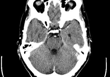 创伤性脑损伤的CT脑扫描的头盖骨。通过Qrons形象。