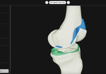 三维数字膝盖规划。图像通过3D系统。