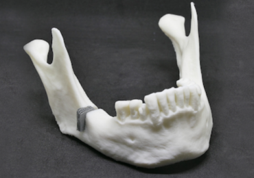 由PLA制成的下颌模型，由锌镁制成的缺陷植入物，基于RWTH DAP新开发的设计和合金概念添加制造。图片来自亚琛工业大学。