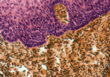 扁桃体表面的光镜切片，显示上皮细胞(粉红色)和下层淋巴组织(棕色)。图片来自安进。